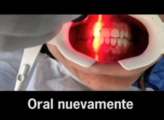 Laser Dental LLLT www.centrodentalsindolor.com